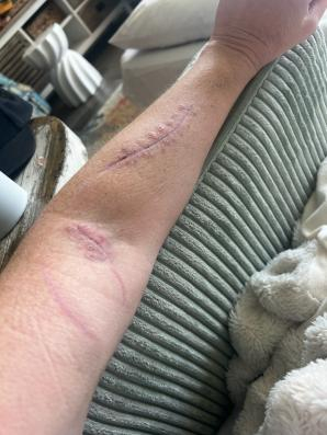 A wife's cut up arm, healing up after the incident.