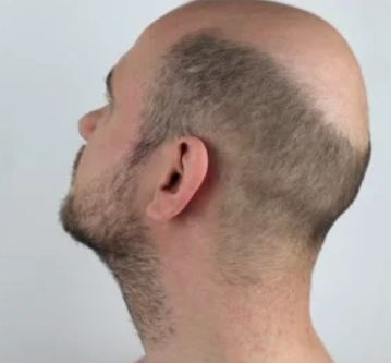 Man with a balding head.